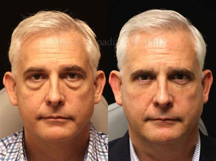 Dan Maurer Update Today – Before & After Surgery, His Death Hoax Debunked
